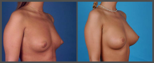 Breast Augmentation - Dr. Hobar