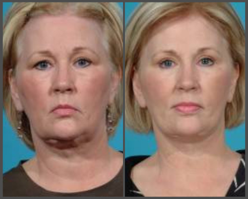 Secondary Facial Rejuvenation